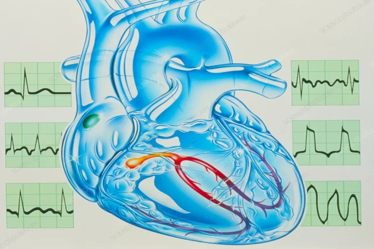 Adagio Medical Prices Up to $50M Private Placement