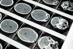 Alzheon Publishes Phase 3 APOLLOE4 Results for ALZ-801 in Early Alzheimer’s Disease