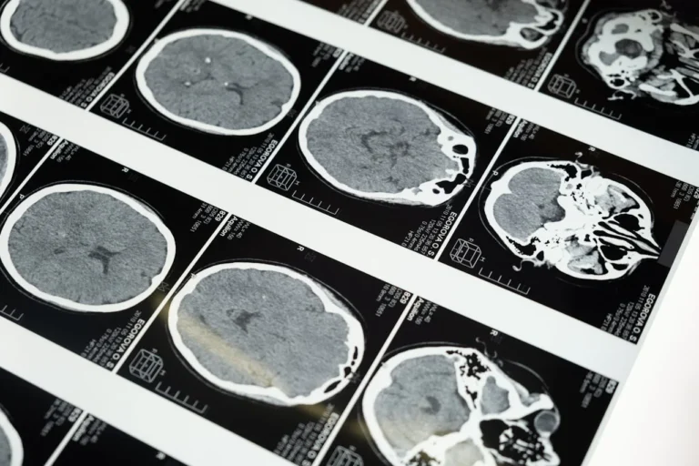 Alzheon Publishes Phase 3 APOLLOE4 Results for ALZ-801 in Early Alzheimer’s Disease