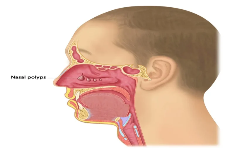 Oticara Reports Positive Phase 2 Results for Novel Nasal Cream in Chronic Rhinosinusitis