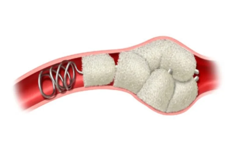 Shape Memory Medical Announces Midway Milestone in the AAA-SHAPE Randomized Controlled Pivotal Trial